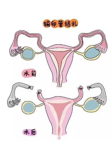 女性結(jié)扎最新方法，探索與理解