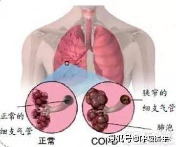 治療慢阻肺的最新藥物